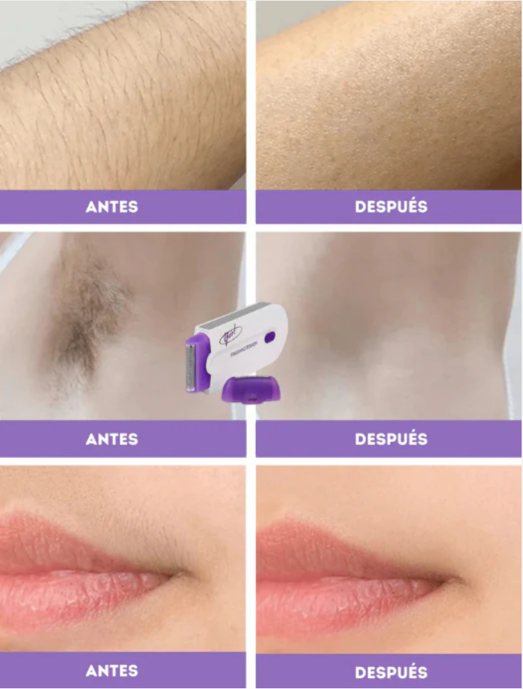 SoftGlow™ – Depiladora portátil sin dolor
